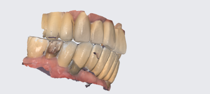 강동구 임플란트 수술 전 확인하면 좋을 3가지 관련 이미지 7