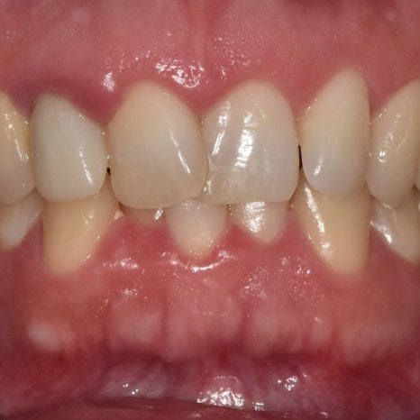 No-Prep Veneers: Do They Really Involve No Tooth Shaving? The 3 Questions Patients Ask Most image 3