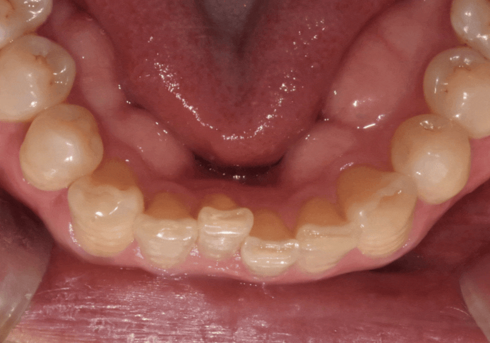 명일역 앞니 부분 교정, 치아 하나만 삐뚤어져 보인다면? 굳이 전체 교정할 필요 없습니다. 관련 이미지 1