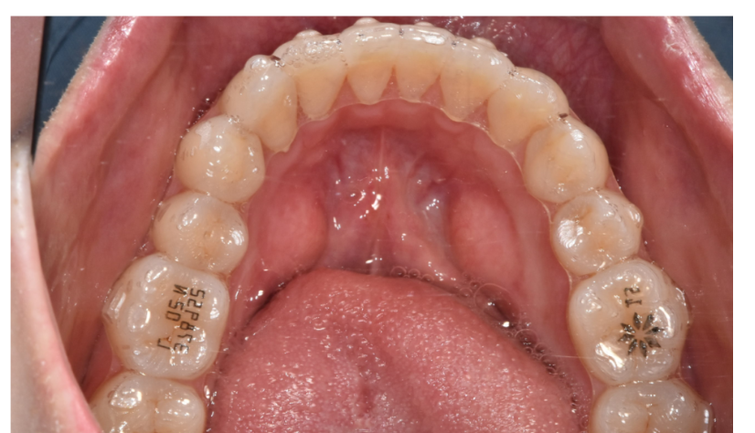 고덕동 투명교정 인비절라인도 철사를 붙일 수 있습니다. 관련 이미지 2