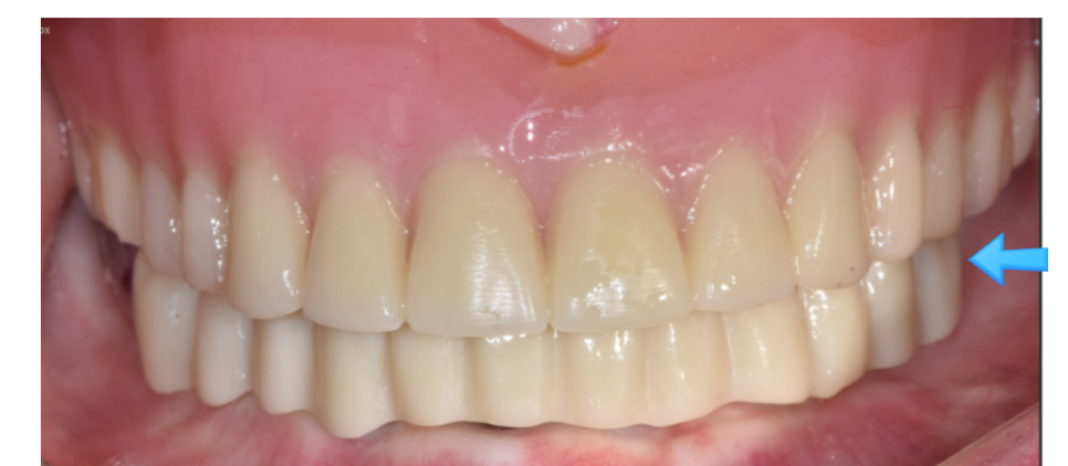 올온포 치아가 다 없어도 임플란트 4개만으로 복원이 가능합니다 관련 이미지 5