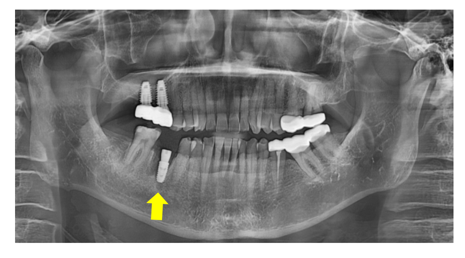 Implant treatment is needed when a gum pimple or pus appears. image 7