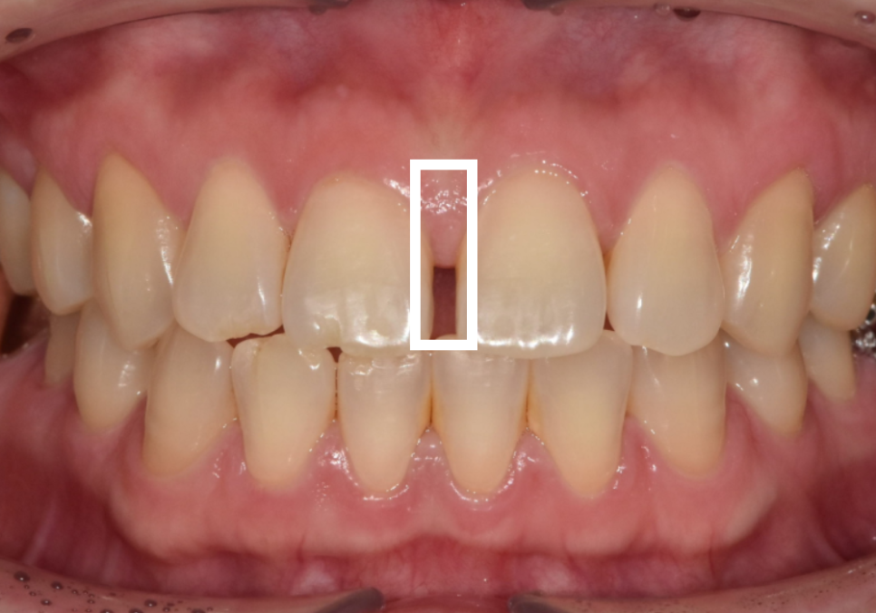고덕동 치간 이개, 위 앞니 벌어짐, 교정? 라미네이트? 고민이시라면 필독 관련 이미지 9