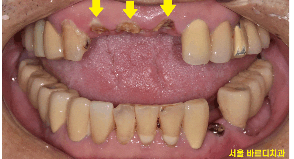 상일동역 치과 부러진 앞니 임플란트로 복구하기 프로젝트 관련 이미지 1