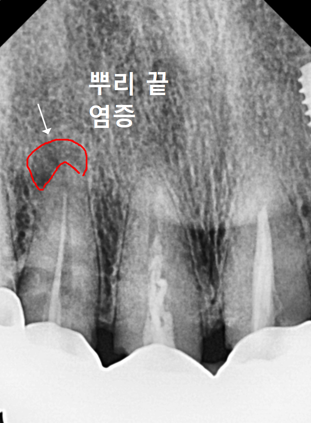 앞니 브릿지 탈락, 씌워둔 게 빠졌어요. 다시 붙일 수 있을까요? 관련 이미지 9