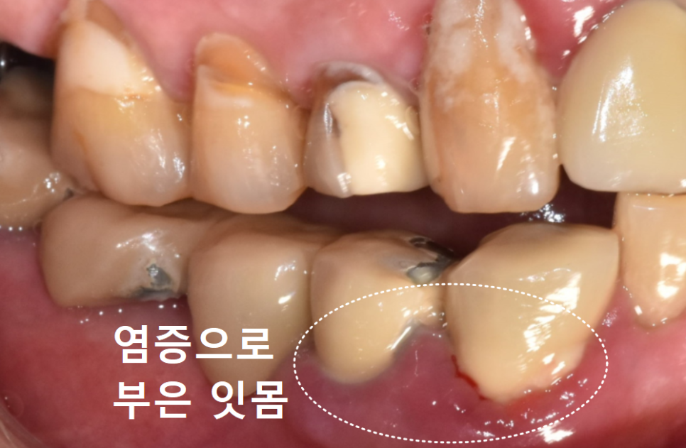 오래된 어금니 롱브릿지, 교체 타이밍을 놓치면 관련 이미지 6