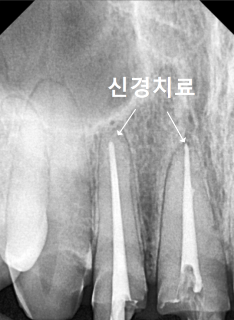 A Single Black Spot of Decay Between the Front Teeth May Be a Warning Sign of Multiple Cavities. image 8