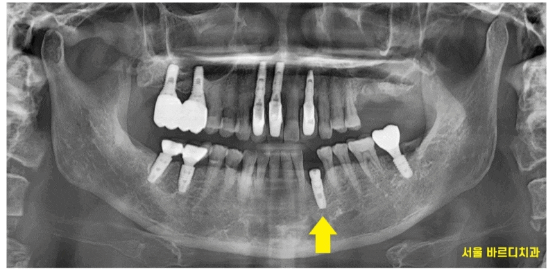 명일동 치과 심미적인 앞니는 하루만에 끝내는 빠른 임플란트로 하세요!! 관련 이미지 1