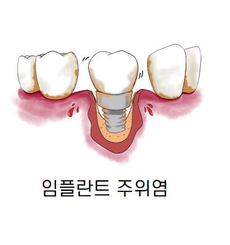 임플란트 잇몸 염증 주위염 증상이 늦게 나타납니다. 관련 이미지 5