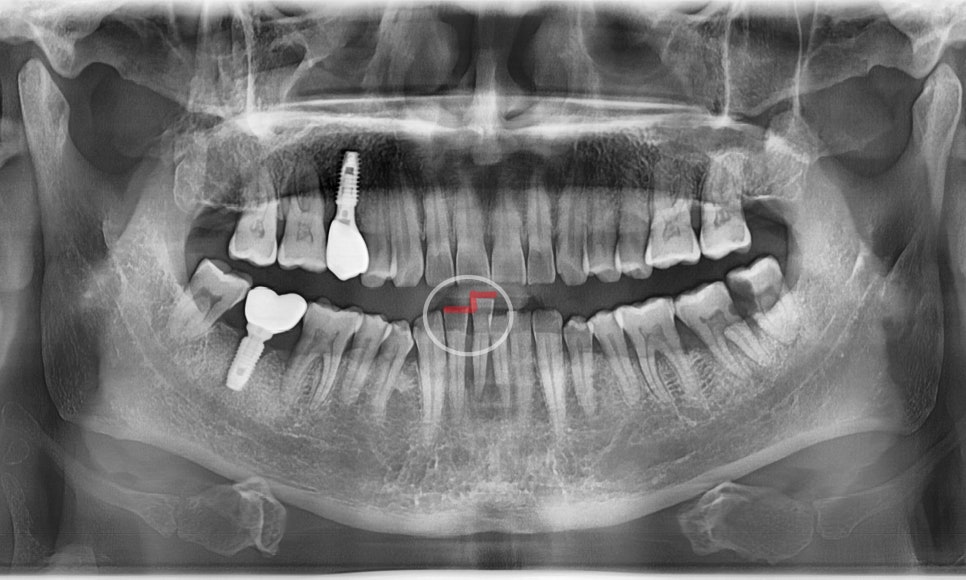 My Teeth Are Shaking So Much That Eating Is Uncomfortable—Is It Okay to Just Leave Them Alone? image 2