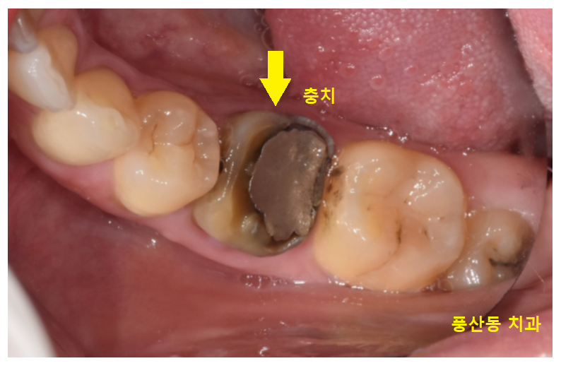 풍산동 치과 임플란트 양쪽 치료 가능한가요? 관련 이미지 6