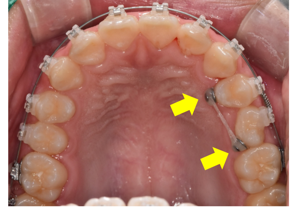 Answering Your Questions About Orthodontic Mini-Screw Placement. (Q&A) image 8