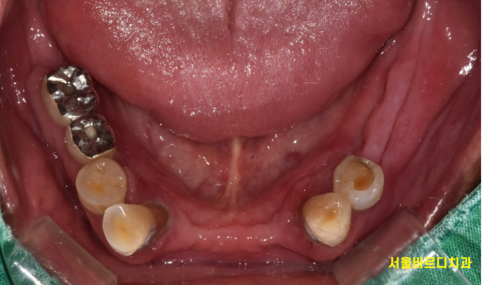 천호동 치과 자연 발치 후 방치된 치아 임플란트 케이스 관련 이미지 4