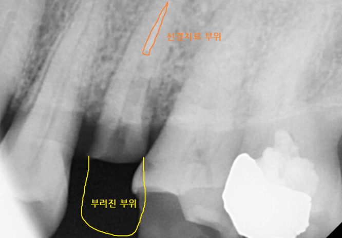 강일동 치과 치아 부러짐 붙일 수 있을까요?? 관련 이미지 4