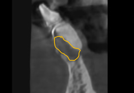 흔들리는 치아 묶어두는 잠간고정술, 오히려 잇몸뼈를 녹일 수도 있다고요? 관련 이미지 9