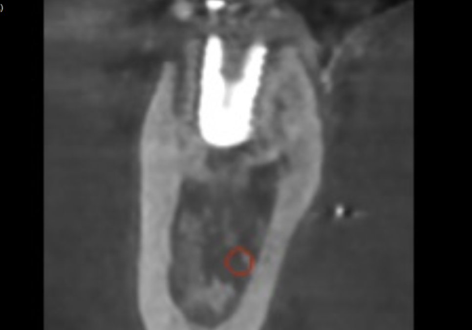 강동구 임플란트 기간, 사람마다 왜 다를까? 즉시식립과 지연식립의 결정적 차이 관련 이미지 15