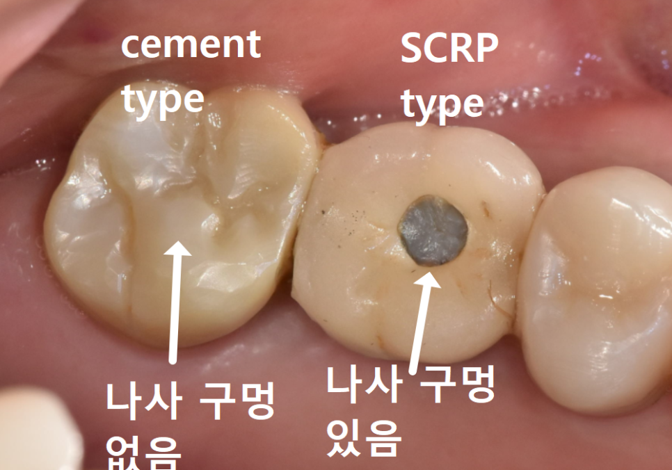 임플란트 움직임, 관련 이미지 3