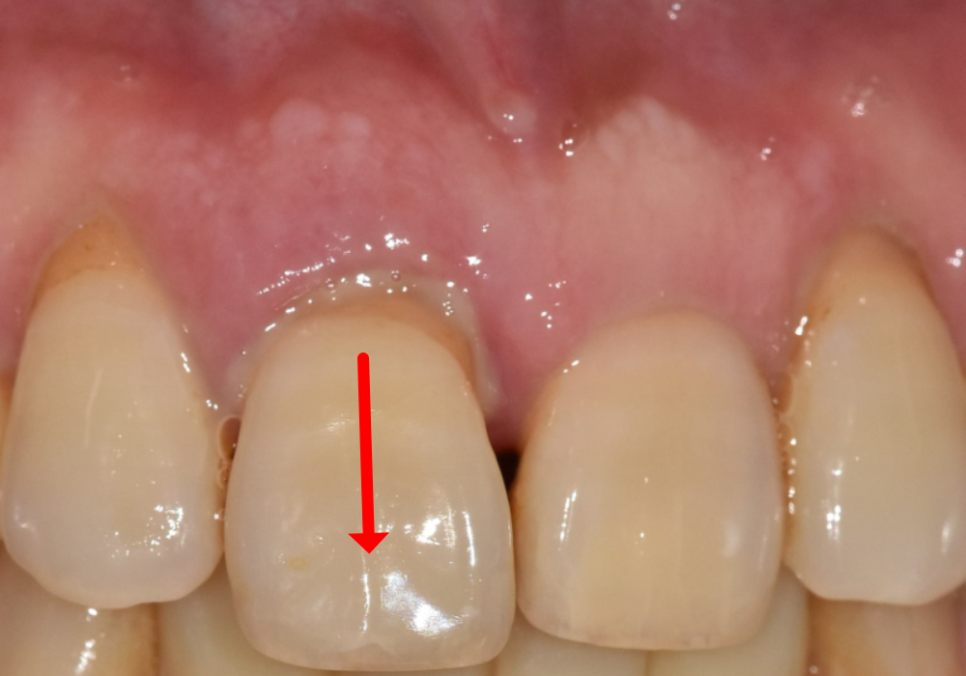 앞니 길어짐, 위 앞니가 점점 내려온다면? 관련 이미지 2
