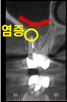 디지털 임플란트 체계적인 수술이 가능한 서울바르디치과입니다. 관련 이미지 6