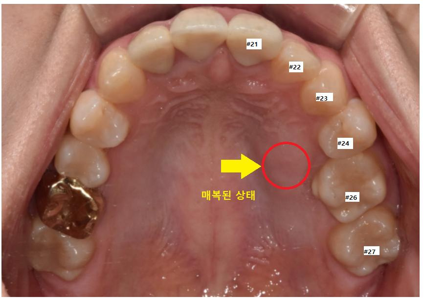 덕풍동 치과 교정 치료 위해 숨어있는 매복치 수술 발치 문제없습니다 관련 이미지 3