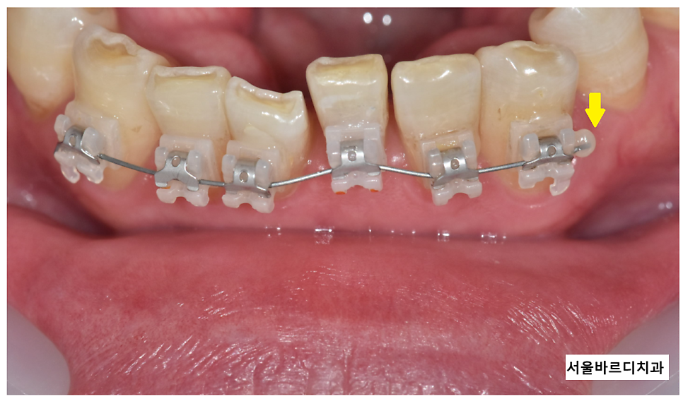 교정기 철사 찔림 원인과 대처법은? 관련 이미지 3
