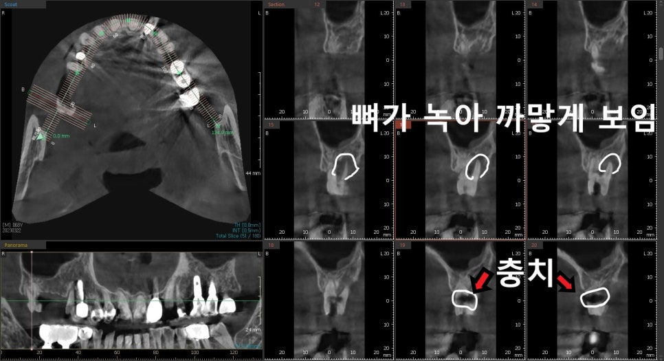 상일동치과, 오래된 크라운 교체 아프지 않은데 계속 써도 될까? 관련 이미지 6