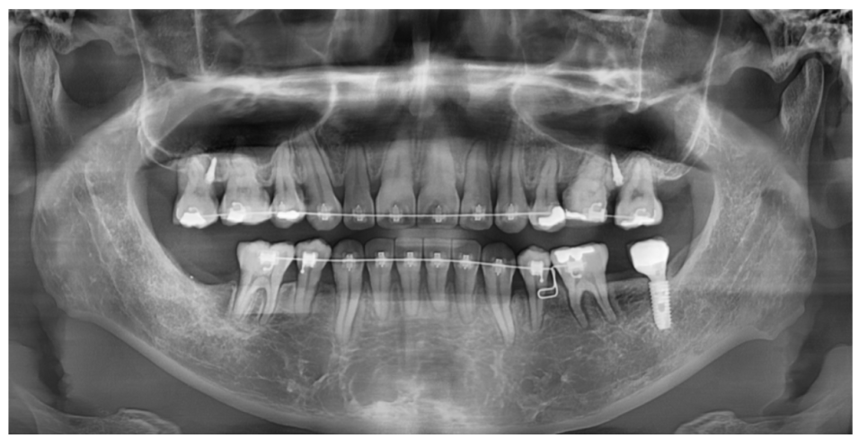 성인 치아교정 기간 평균 2년이 소요되는 까닭은? 관련 이미지 2