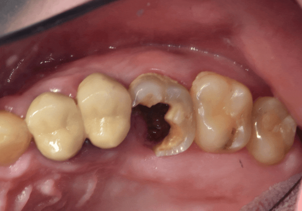 어금니 구멍, 충치 솔직하게 말씀드립니다. 치과 공포증으로 미루신 분들 필독 관련 이미지 2