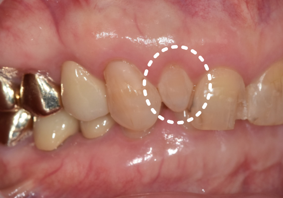 무삭제 라미네이트 적응증, 당신이 미처 몰랐던 시술의 조건을 공개합니다. 관련 이미지 4