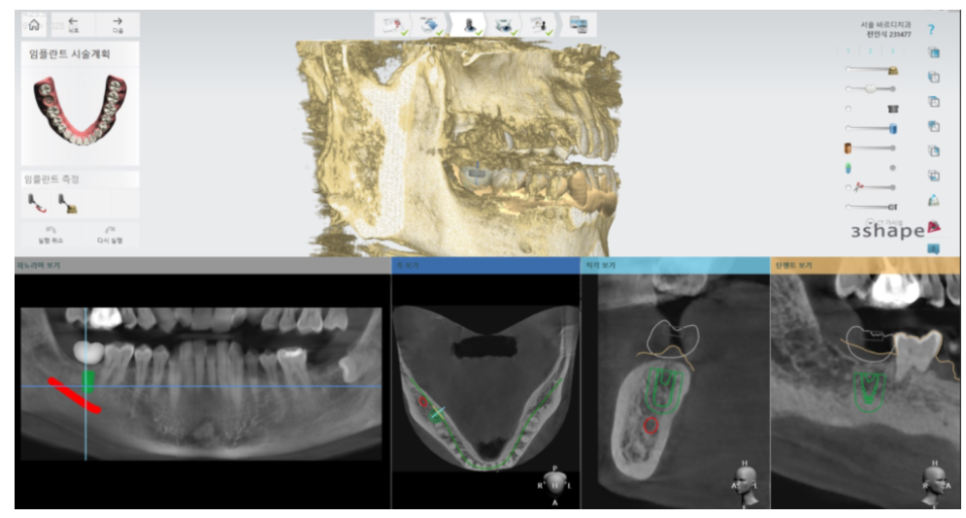 길동 임플란트 내원 횟수 얼마나 와야하나요?? 관련 이미지 2