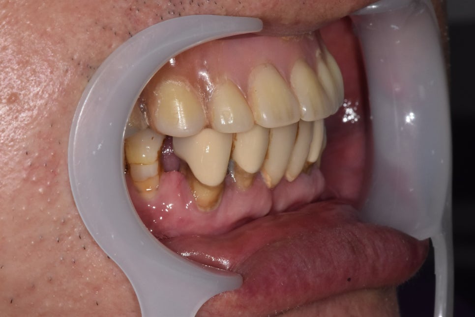 얇은 잇몸뼈, 임플란트 거부 당했다면? 상악동거상술로 해결할 수 있습니다. 관련 이미지 13