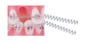 치아 교정 스프링 공간을 확보하기 위한 오픈코일 알아봐요 관련 이미지 5