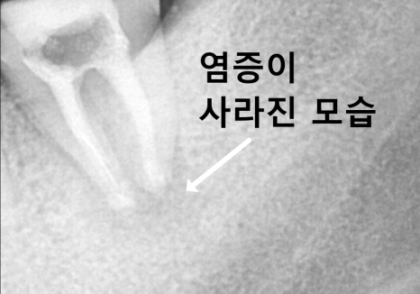 어금니 염증, 자연치 살리기에 진심인 저는 이렇게 살렸습니다. 관련 이미지 11