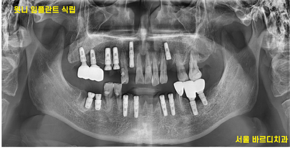 녹아버린 잇몸뼈 흔들리는 여러 치아 발치 후 임플란트 시행 관련 이미지 8