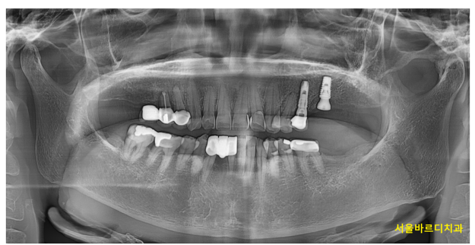임플란트 수술 통증과 붓기 시기별 회복 과정 총정리! 관련 이미지 1