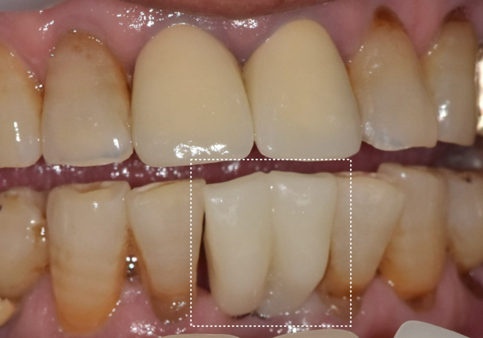 강동구 임플란트 가격 줄이는 방법 2개 발치했는데, 1개만 심어도 된다구요? 관련 이미지 11