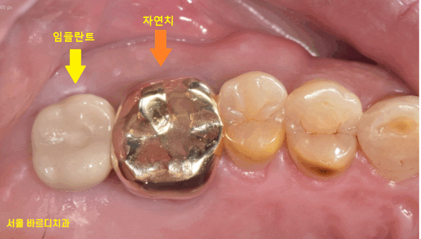 고덕역 근처 치과 임플란트 크라운 크기 크면 다 좋을까요?? 관련 이미지 1