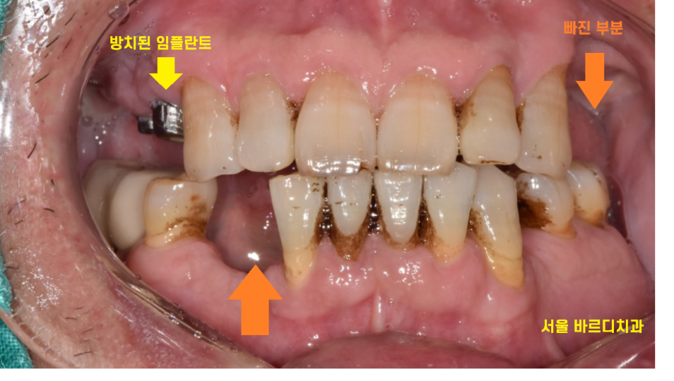 상일동역 근처 치과 타원 임플란트 제거 후 재식립 케이스 관련 이미지 3