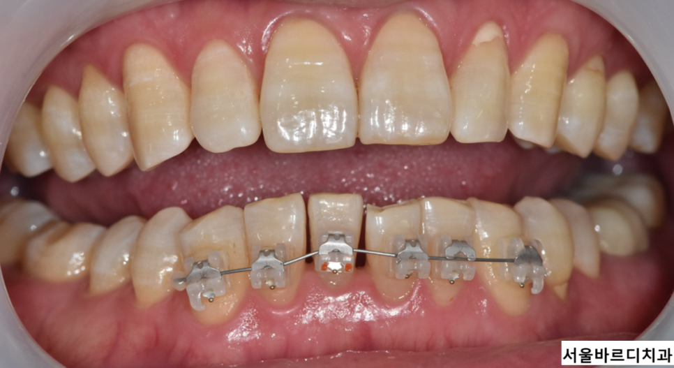명일동 치아 교정 타이밍 언제 시작하는게 좋을까? 관련 이미지 5