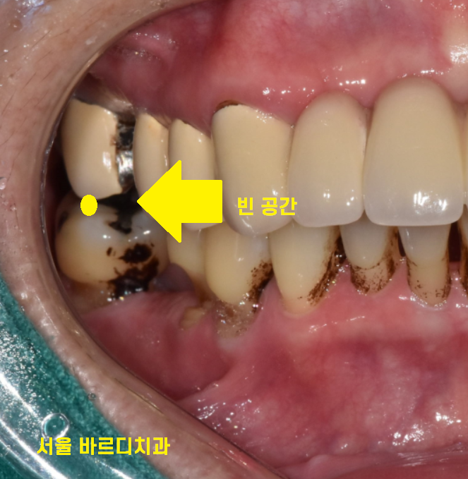 고덕역 치과 빠진 어금니 방치 그대로 두다가는 임플란트가..? 관련 이미지 6