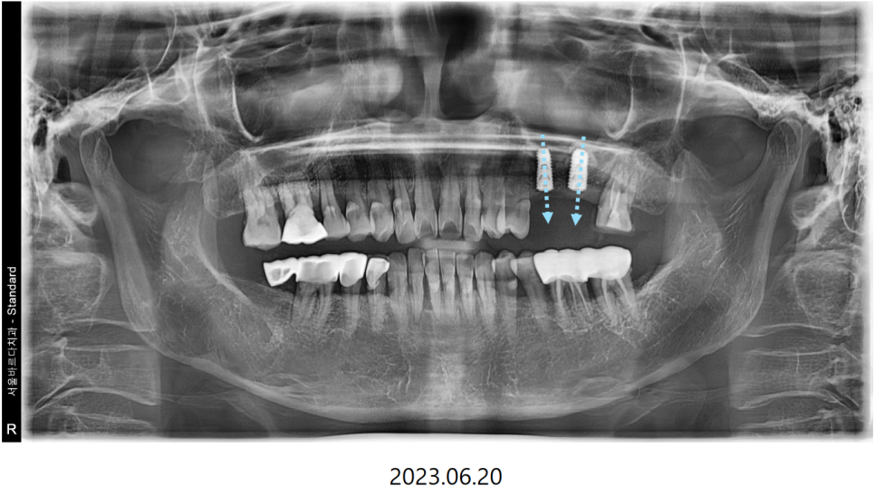 고덕동치과 서울바르디치과 무절개 네비게이션 임플란트 치료증례 #2 관련 이미지 14