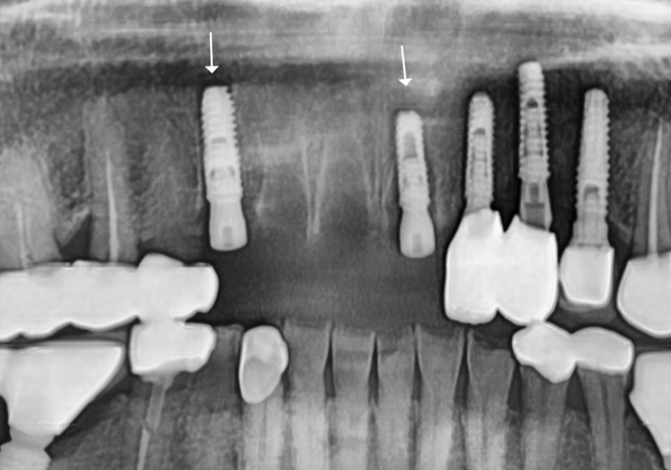 앞니 브릿지 탈락, 씌워둔 게 빠졌어요. 다시 붙일 수 있을까요? 관련 이미지 12