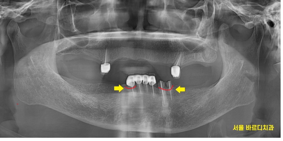 강일동 치과추천 틀니 사용중 치아 부러짐 임플란트로 복구했습니다. 관련 이미지 4