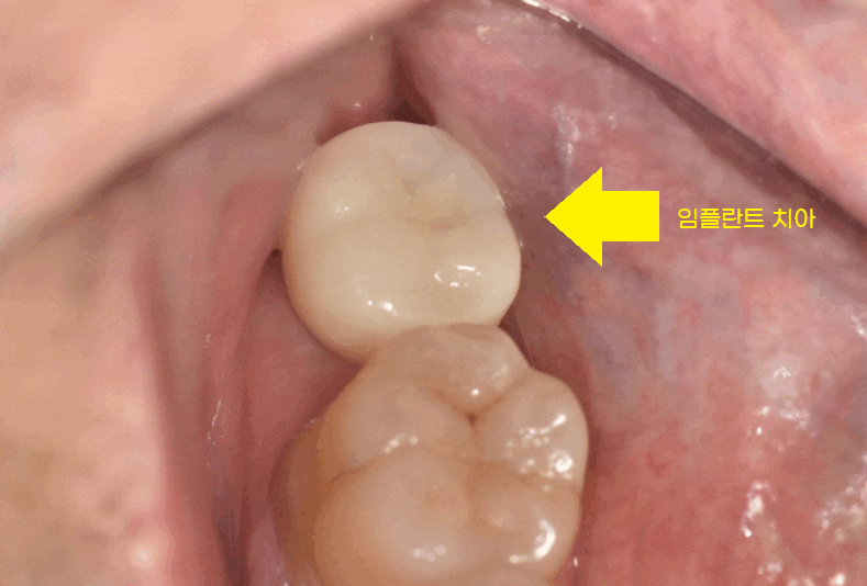 덕풍동 치과 잇몸 욱신 욱신 원인 찾아 임플란트 수술하였습니다. 관련 이미지 1