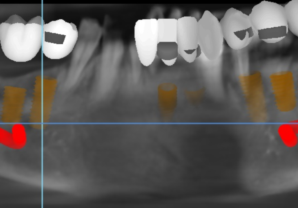 천호 디지털 가이드 임플란트, 일반 임플란트와 무슨 차이가 있나요? 관련 이미지 1