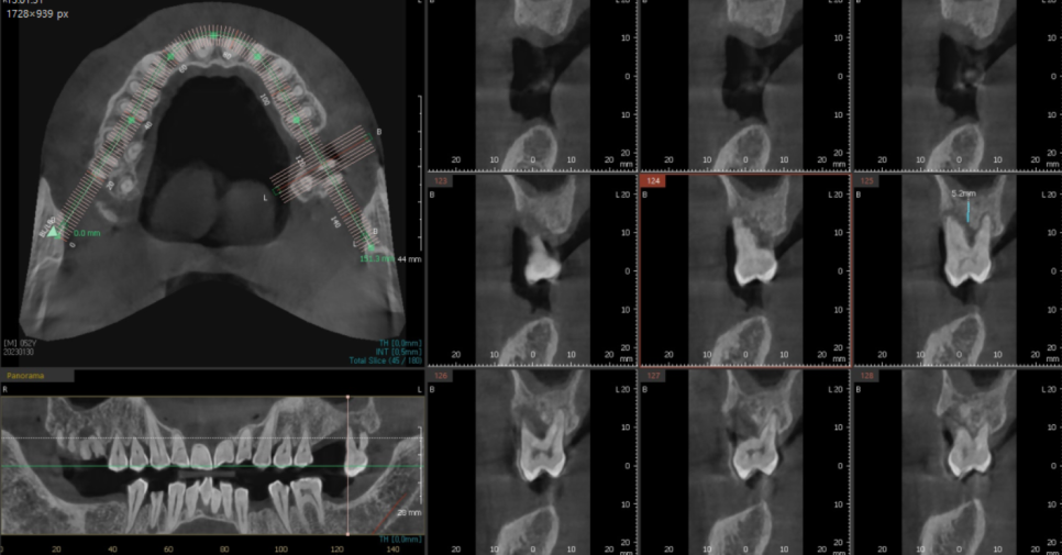 망월동 치과 어금니 빠짐 임플란트 대안이 될 수 있습니다. 관련 이미지 6