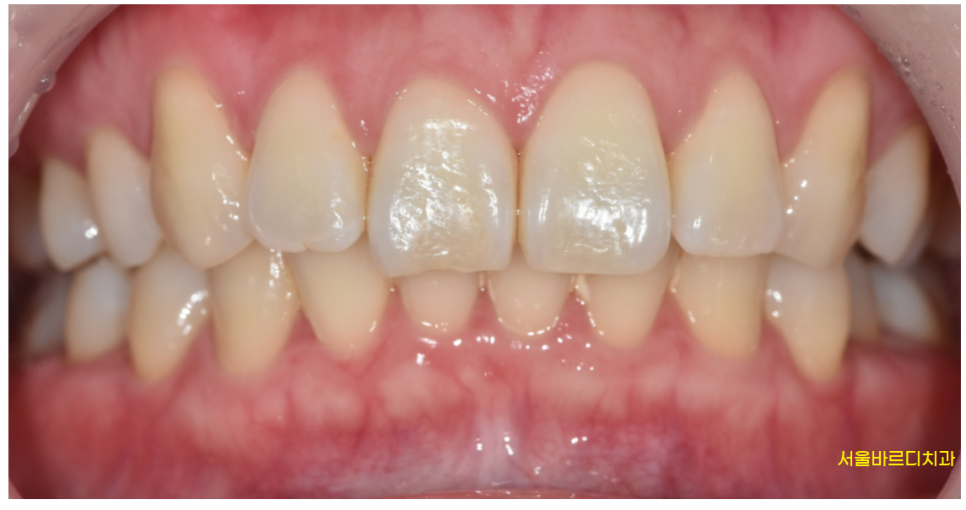 상일동 치아미백 가격, 횟수 궁금하신 부분 싹 정리했습니다. 관련 이미지 2
