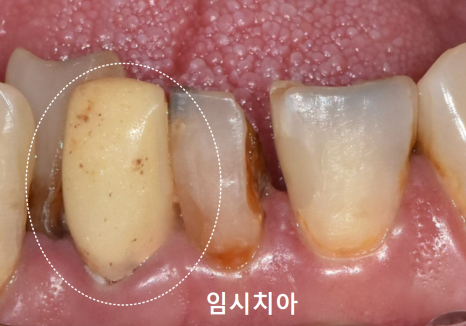 Honestly, Can an Unbroken Temporary Tooth Be Used Without a Crown? image 4