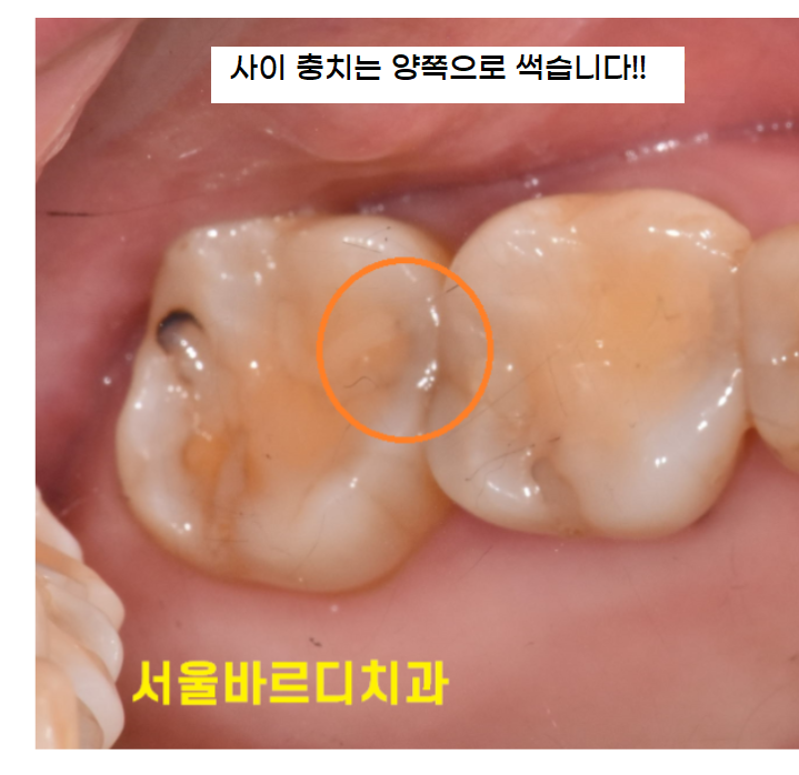 강동구 치과 충치는 전염될까?? 다른 치아로 옮겨갈까? 관련 이미지 3