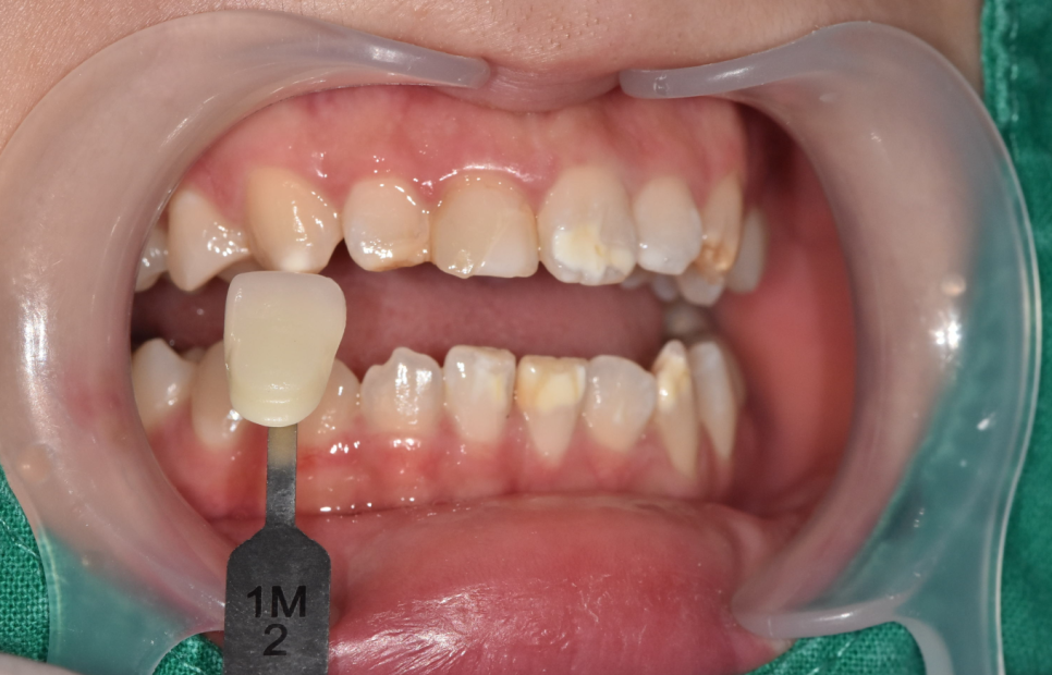 강동구 라미네이트, 치아 하얀 반점 없애고 싶다면? 치료 방법 관련 이미지 11